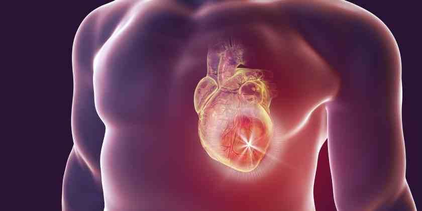 Enfermedad del “Corazón Roto” en Covid-19