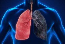 Salud Global/ Dejar de fumar No borra las huellas del tabaco en los pulmones